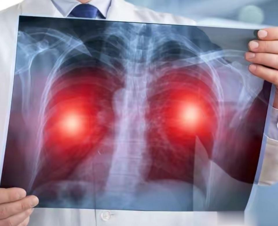 什么时候需要排查是否有肺炎，你知道吗1.高热不退，比如持续5天，还在39度以上2