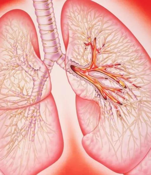 慢性支气管炎——我有一张“断根方”，从医30年珍藏，今日公开分享！

不少中老年