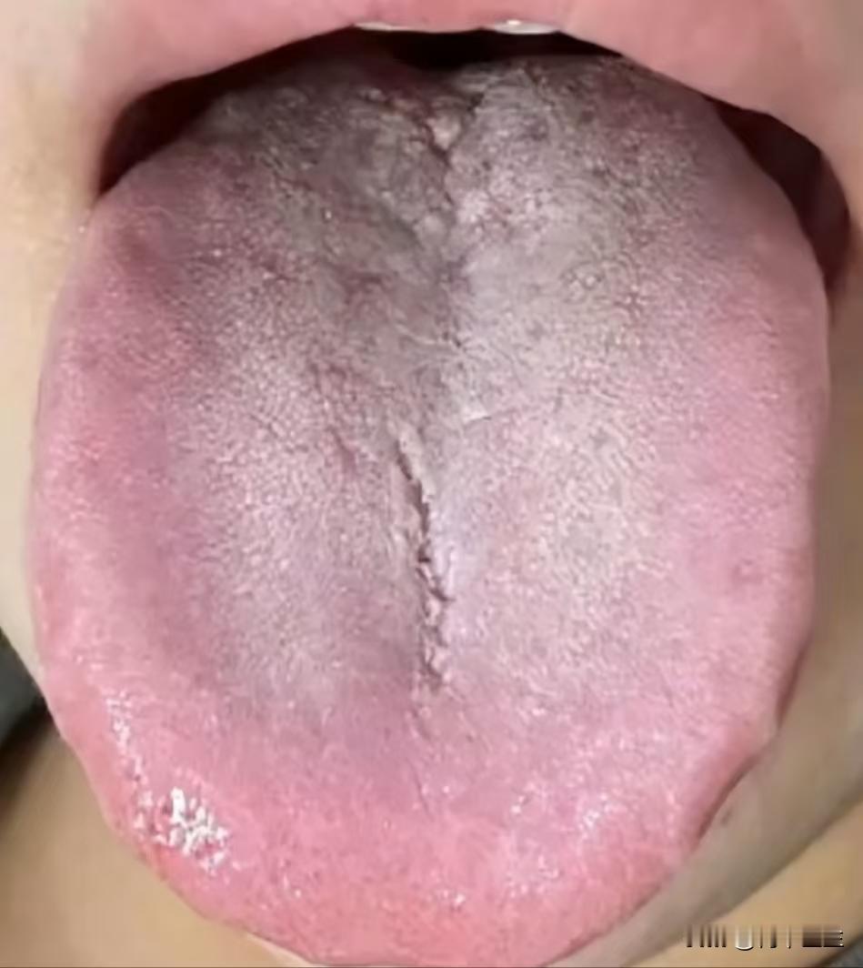 舌头有裂纹，这可不是脾虚，是你的阳虚，别再傻乎乎的健脾了，没用啊

好多人已经被