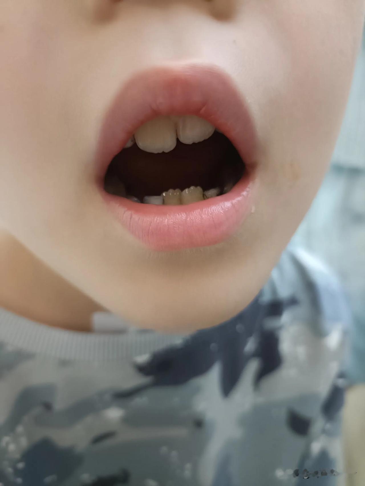 为什么小孩一颗牙能长3个尖点？