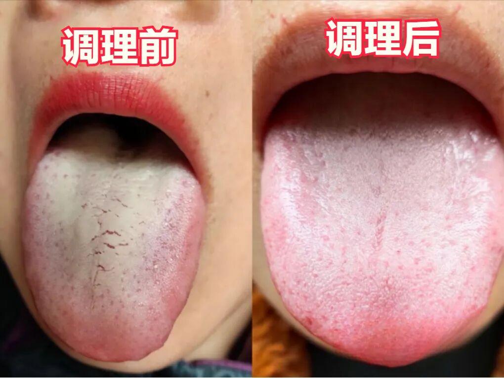 面对这样的舌象，如果你以为仅凭健脾就能了事，那可就大错特错了！这位女粉丝曾经尝试