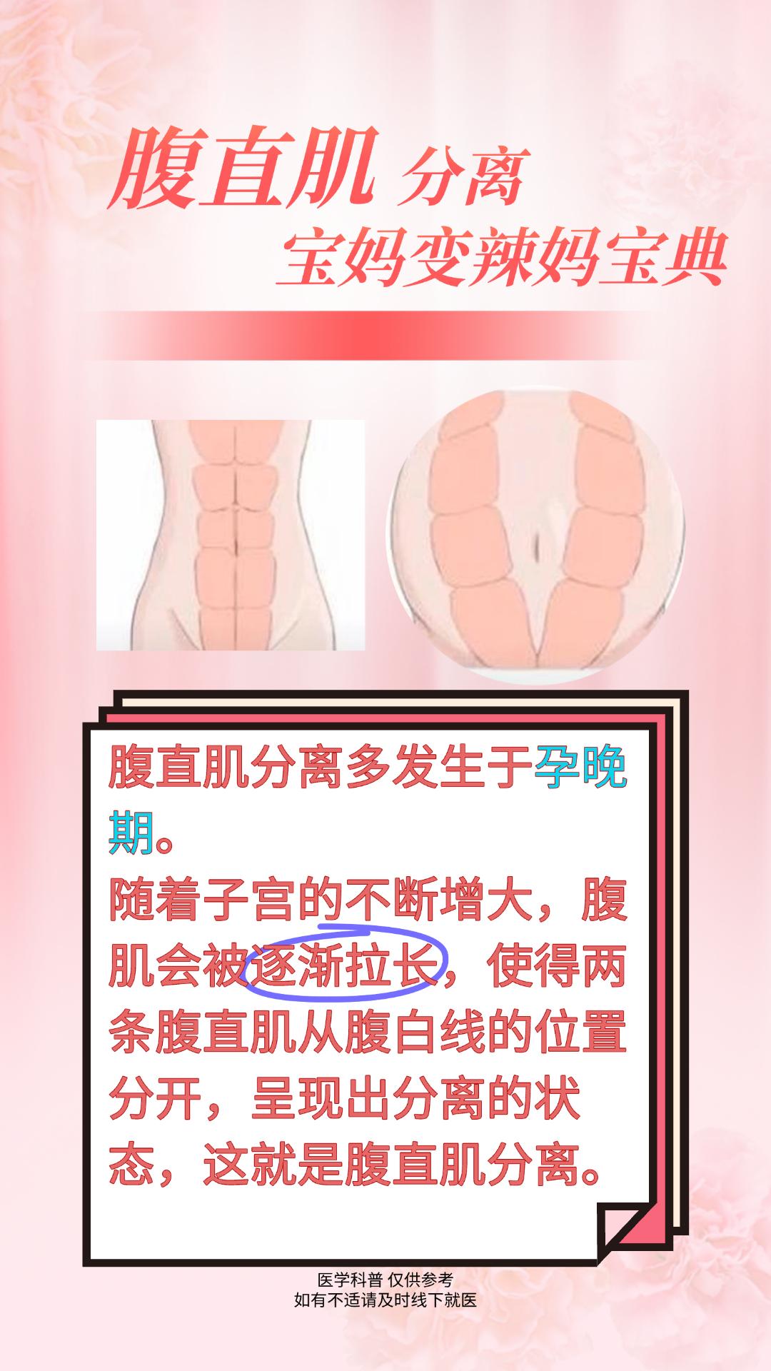 改善腹直肌分离，新手妈妈也能变少女。