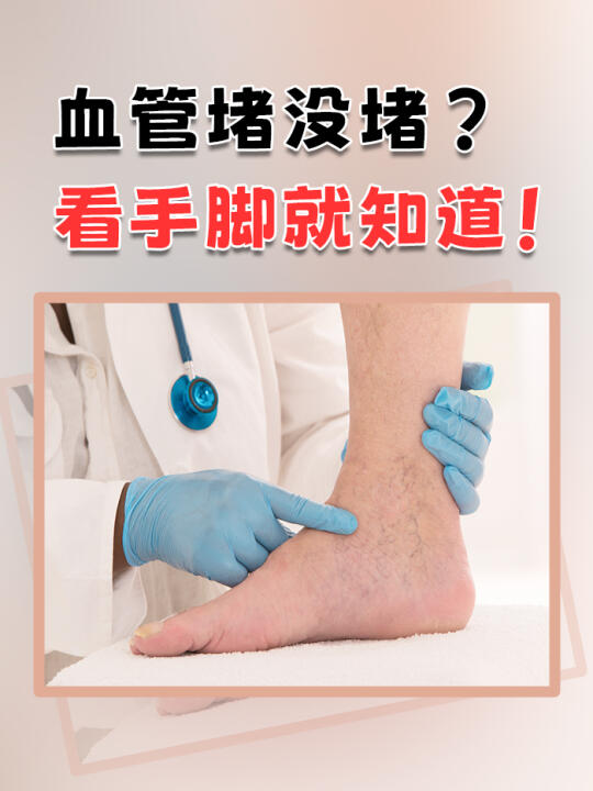 血管堵没堵？看手脚就知道！