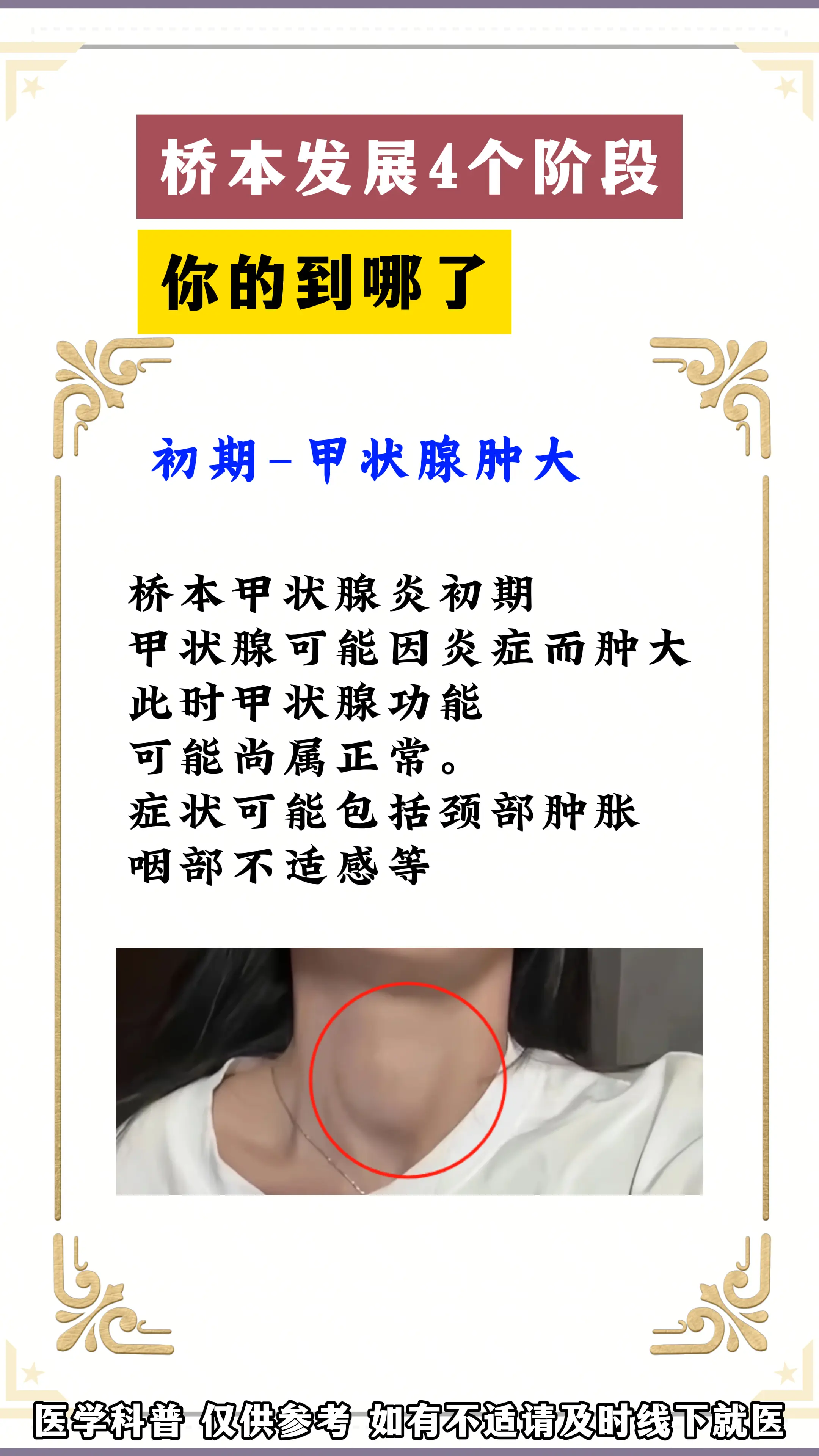 桥本氏甲状腺炎 健康科普