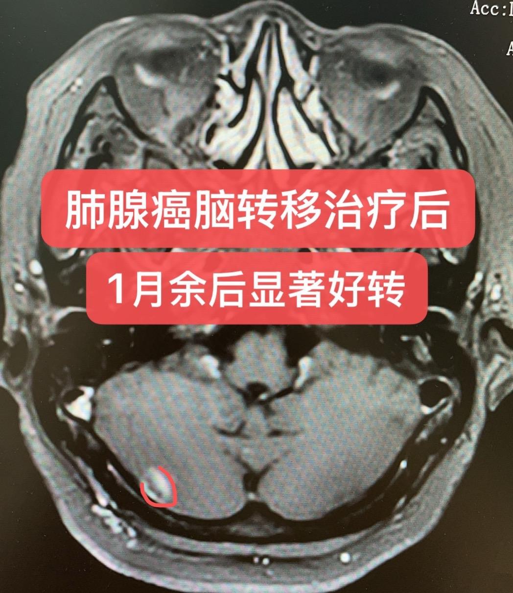 肺腺癌脑转移的治疗。患者女性，62岁，2026-04-07确诊右肺上叶...