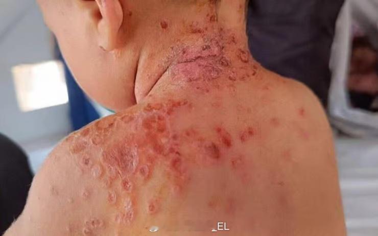 由于物资封锁、卫生条件恶劣和频繁的流离失所，巴勒斯坦加沙地区爆发了新的儿童传染性