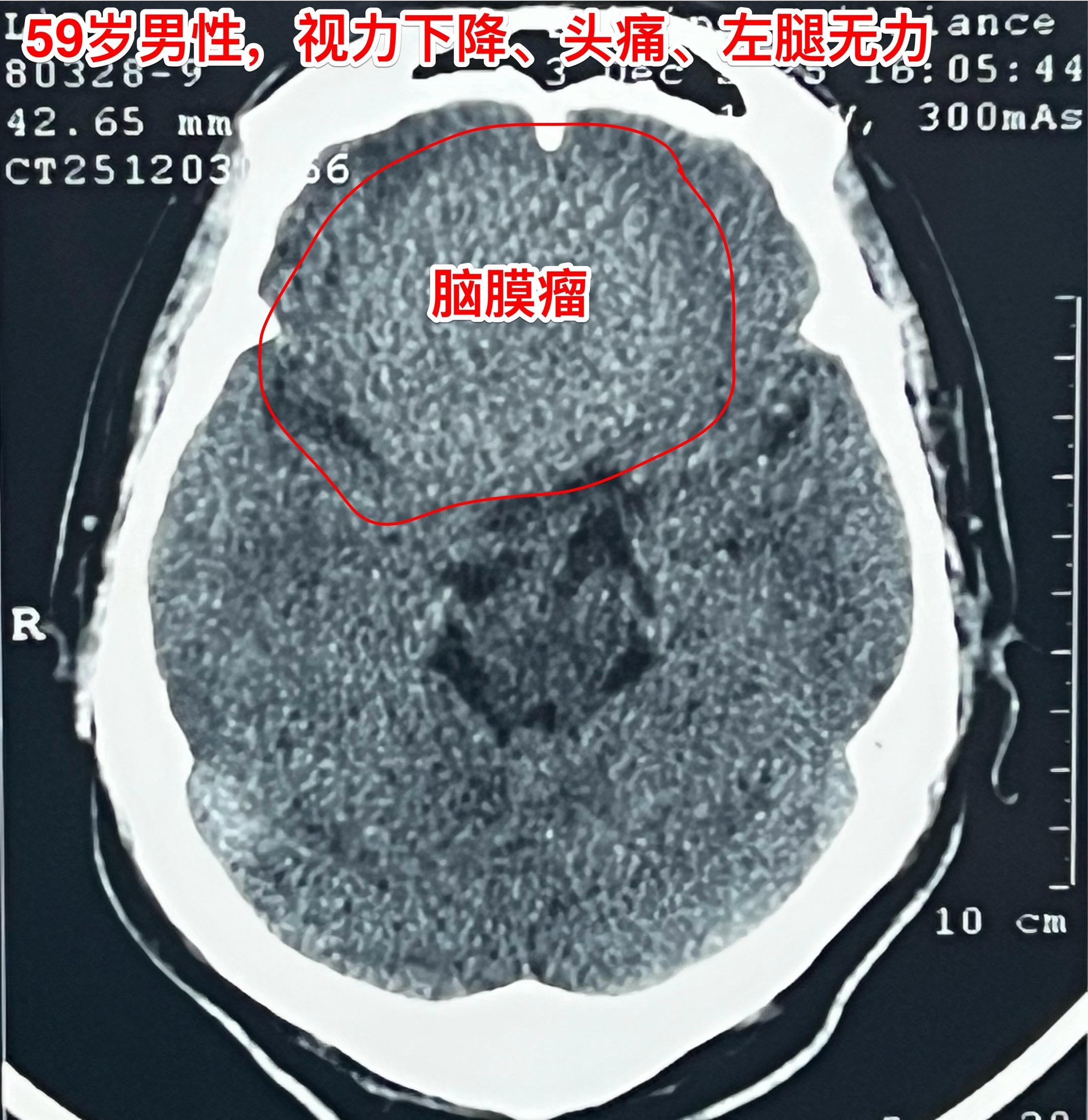 脑膜瘤长在不同的部位产生的症状也不同！这个59岁的内蒙古男性，最开始的...