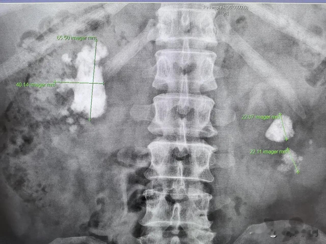 看到福州泌尿外科吴翔主任对肾结石的科普（图1-图3），再看张煜老婆在售货群里面的