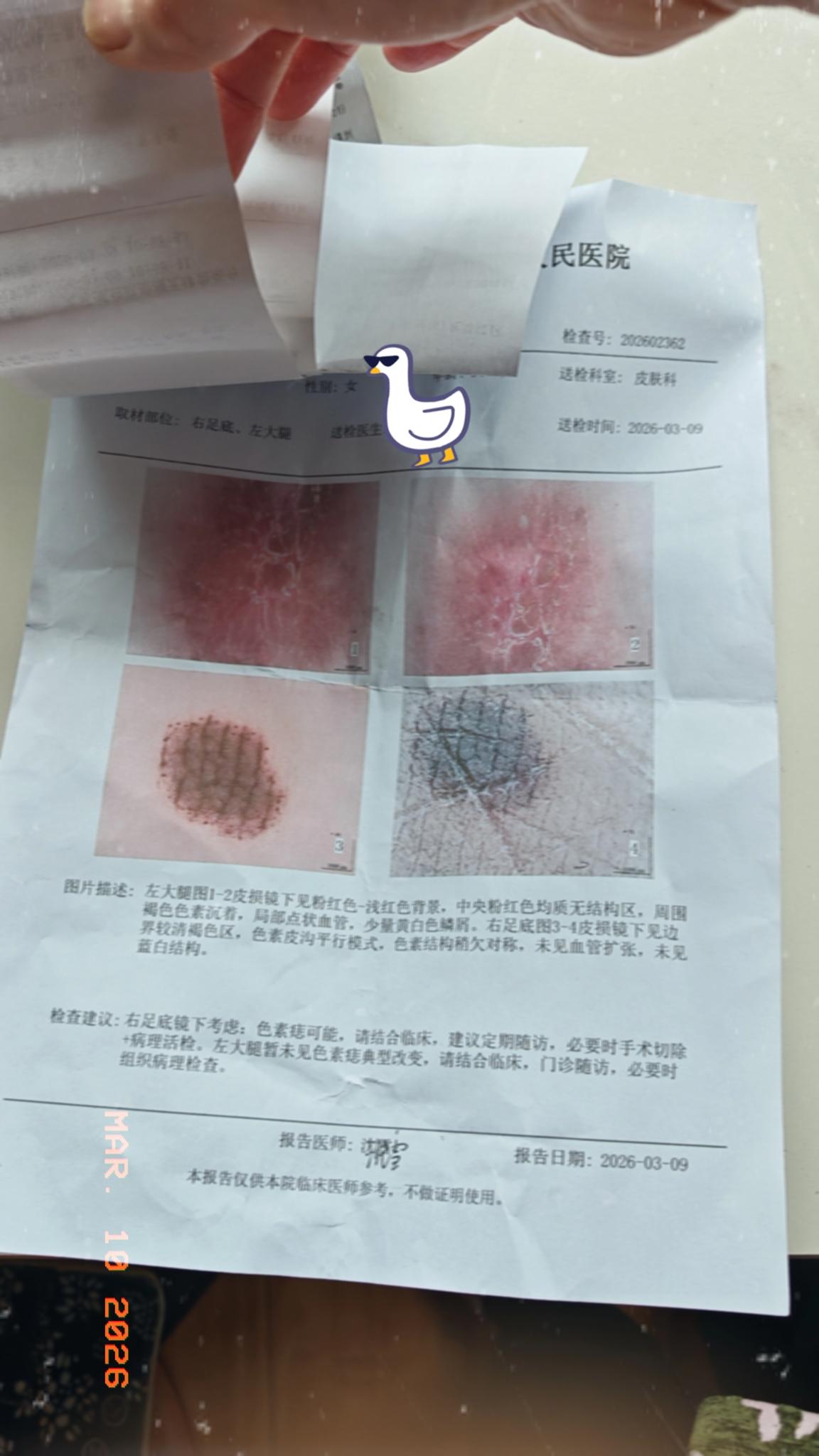 我大腿内侧长黑色斑块已有十五年。昨天去成都市二医院皮肤科检查，已排除黑色素瘤的可