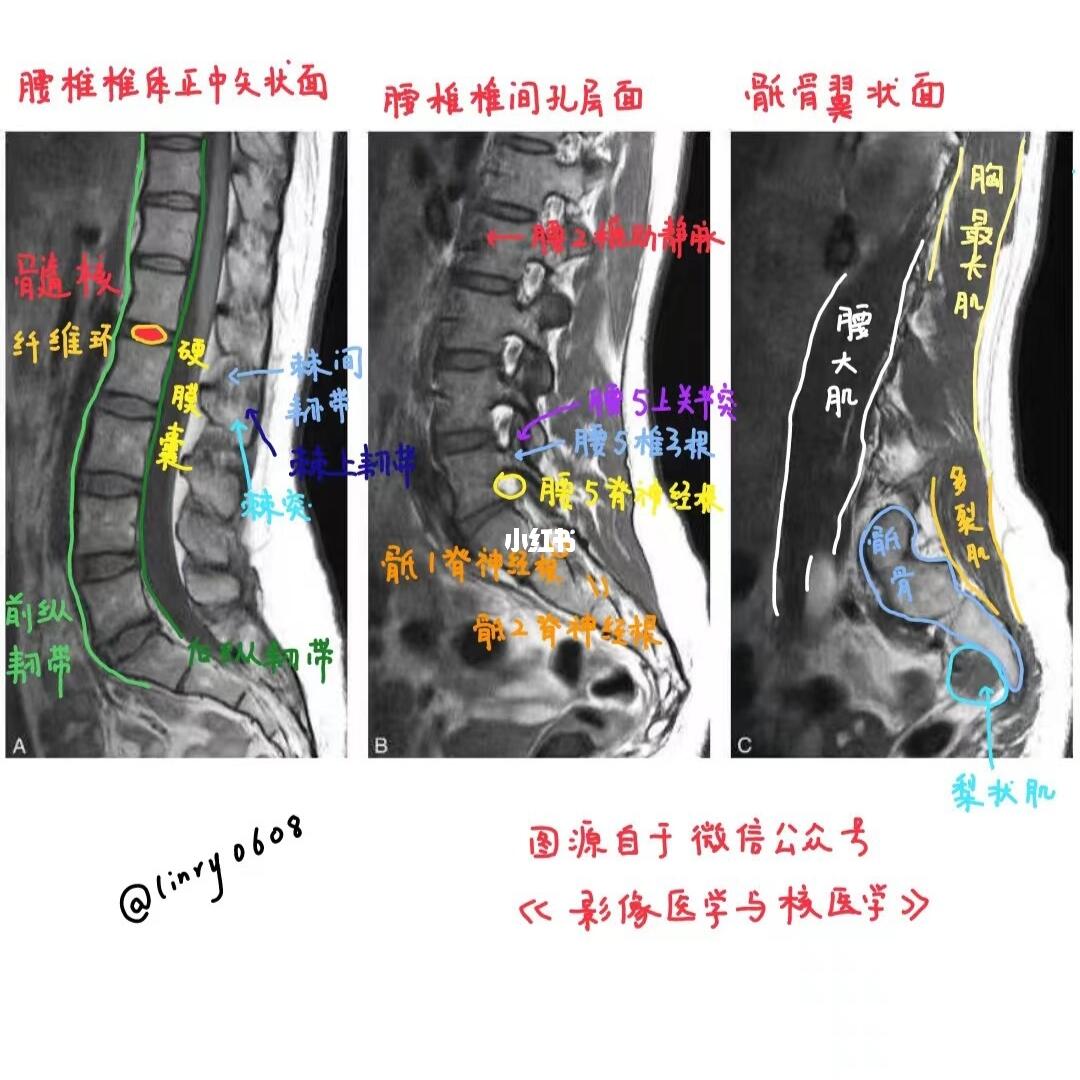 医学生绘本🎨第95弹【腰椎MRI】