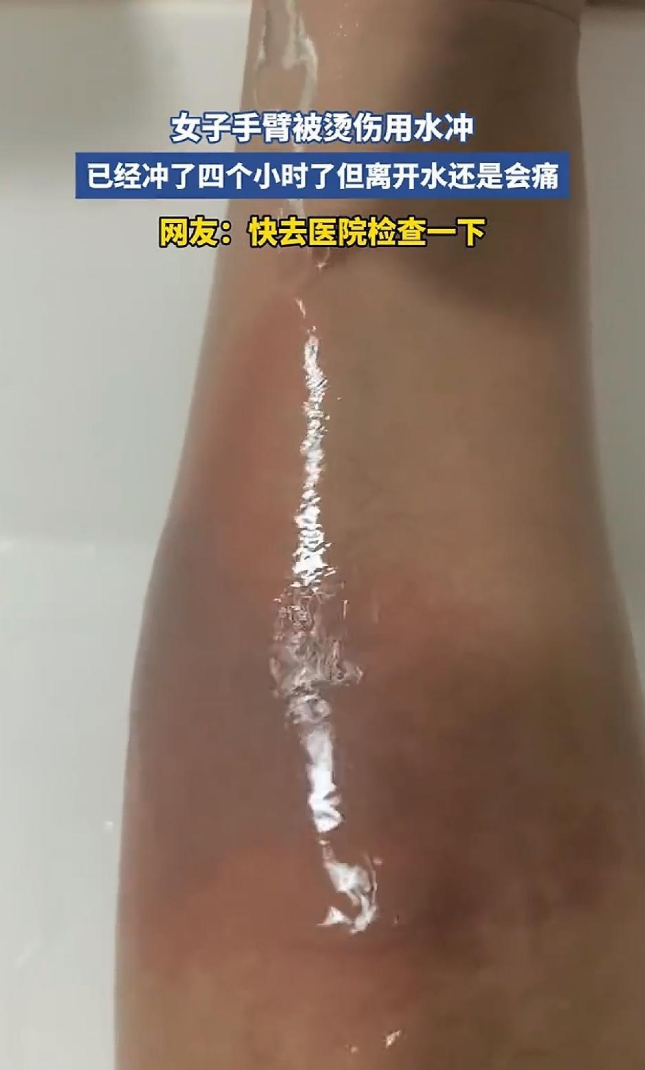 山东，一女子手臂不慎被烫伤，于是女子赶紧用流动水冲烫伤部位，结果没想到女子这么一