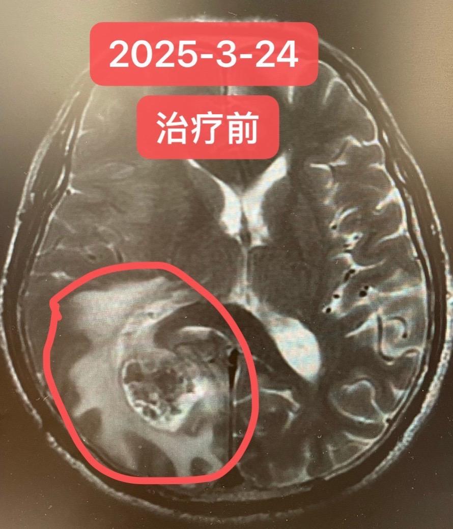 肺鳞癌脑转移的综合治疗。患者男，71岁，头晕1周！完善检查：肺部占位...