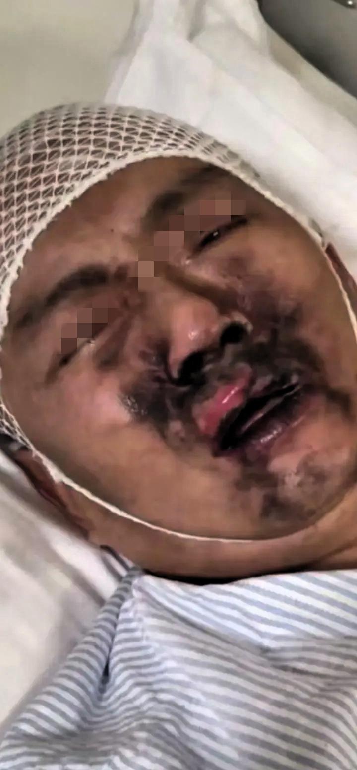 真倒霉到家了，男子住院吸氧气期间，趁医生不在，自己偷偷吸烟，结果引发氧气爆炸，脸