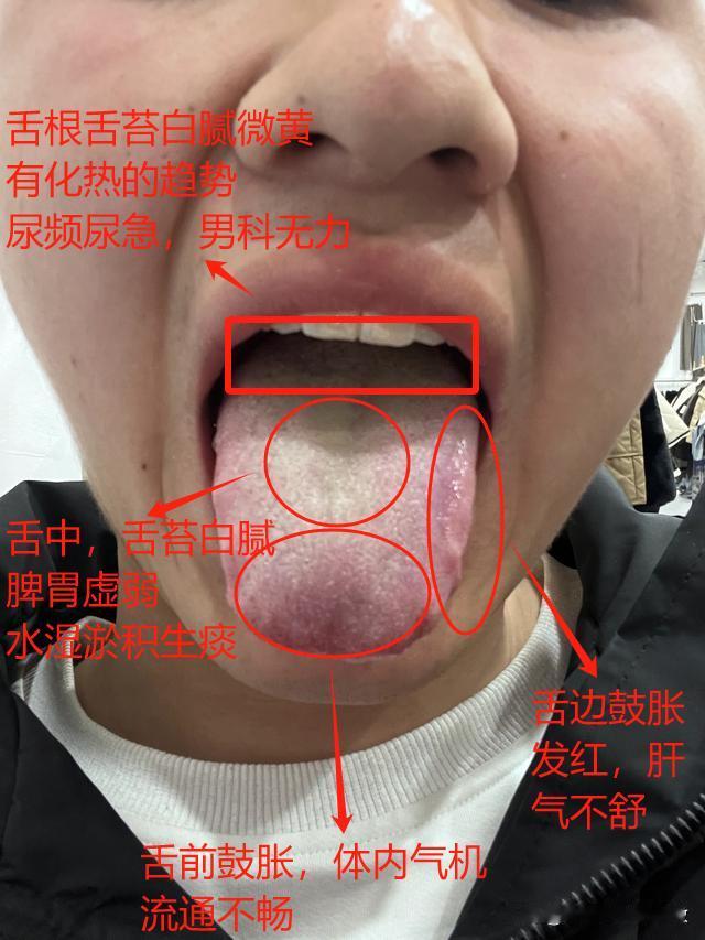 门诊男科接诊最多的舌像，简单给大家划了一下[碰拳][碰拳][碰拳]
有问题可以自