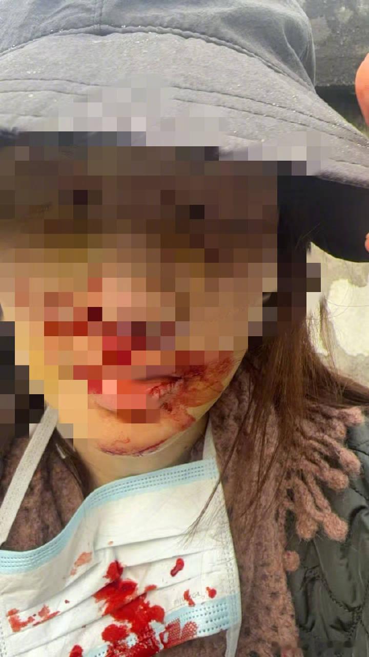 金晨道歉金晨鼻子受伤，撞的这么严重啊，“为躲避路上蹿出的小狗，撞上了警示牌和房屋