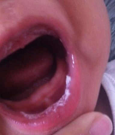 对反复发作的鹅口疮，最主要的原因还是清洁的不够，导致反复念球菌感染。当然，还有少