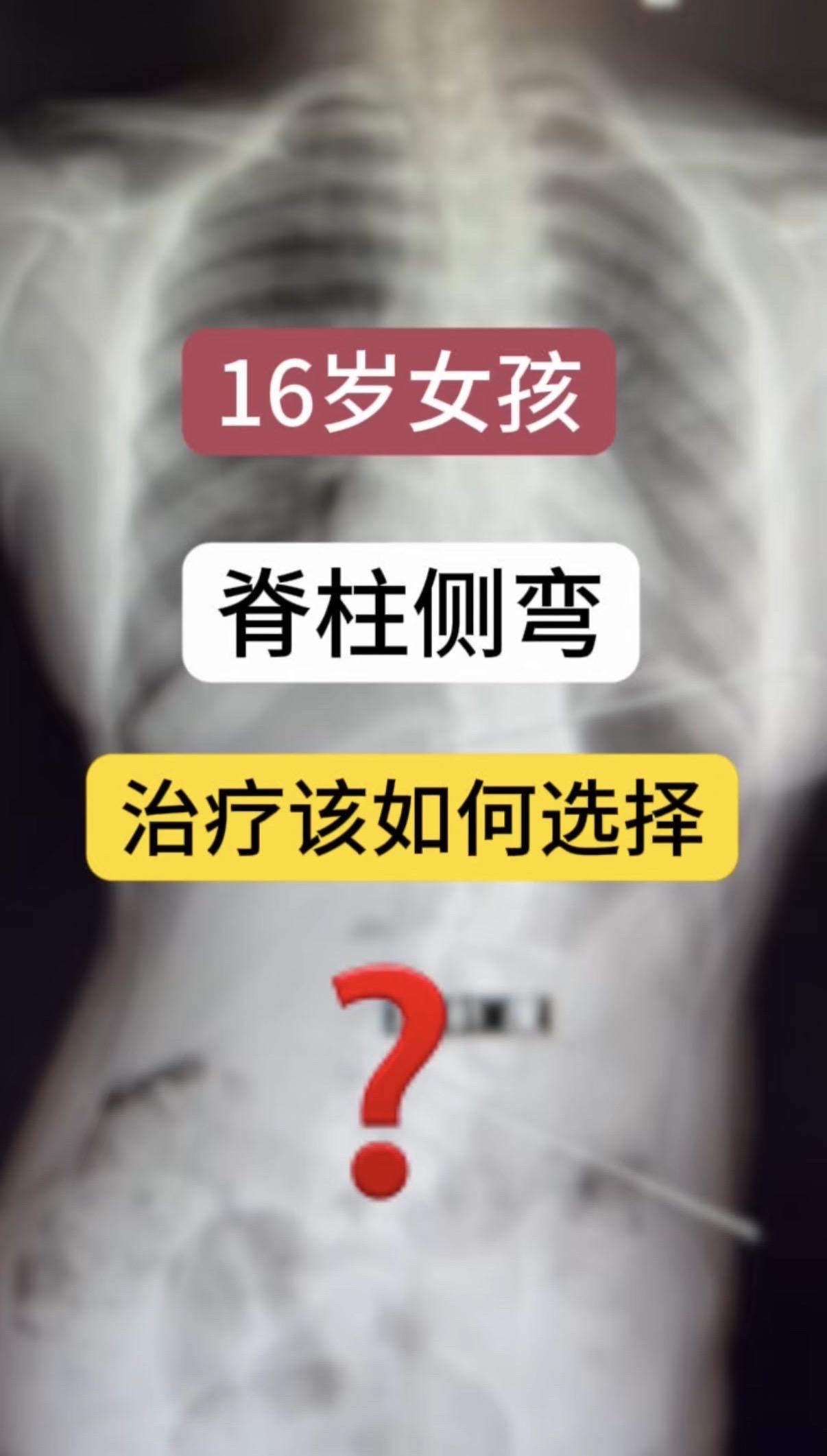 16岁女孩，脊柱侧弯，治疗该如何选择？