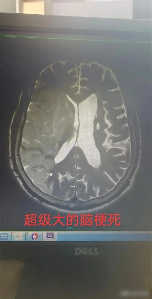 慢慢就体会了，这世上有两种恐怖的病，一是癌症，二是中风。

以前我总觉得中风都是