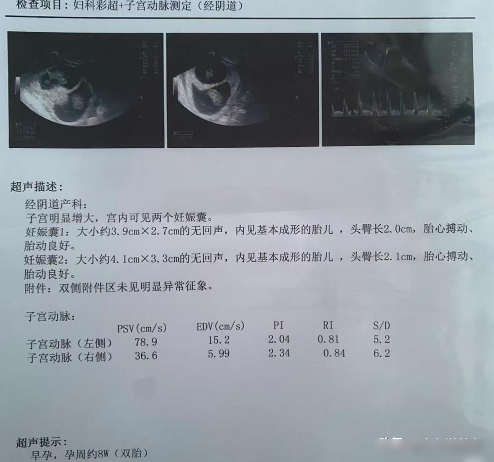 48岁意外怀双胞胎，这抉择真的太难了

我老公的堂姐48岁了，老大都上班了，例假