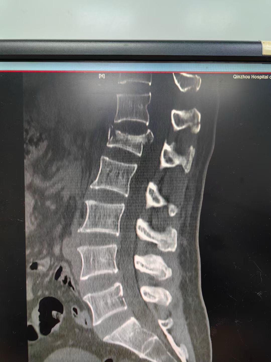 腰1爆裂性骨折，通过闭合复位也是能达到理想的