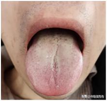 那方面不及格，不能只看舌根！就像这个患者，看似病在肾，实则在肝、脾！
舌根区域收