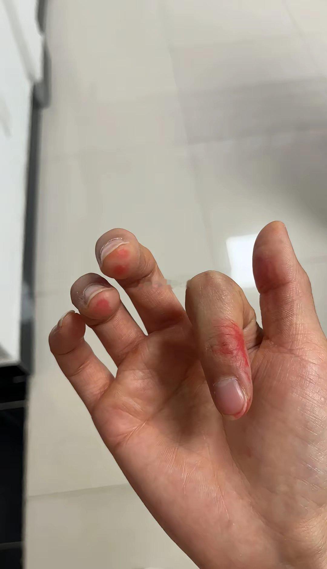 柳南的地铁口一男子专门针对女孩子喷洒这种液体，只希望不要再有女孩子受伤害了 