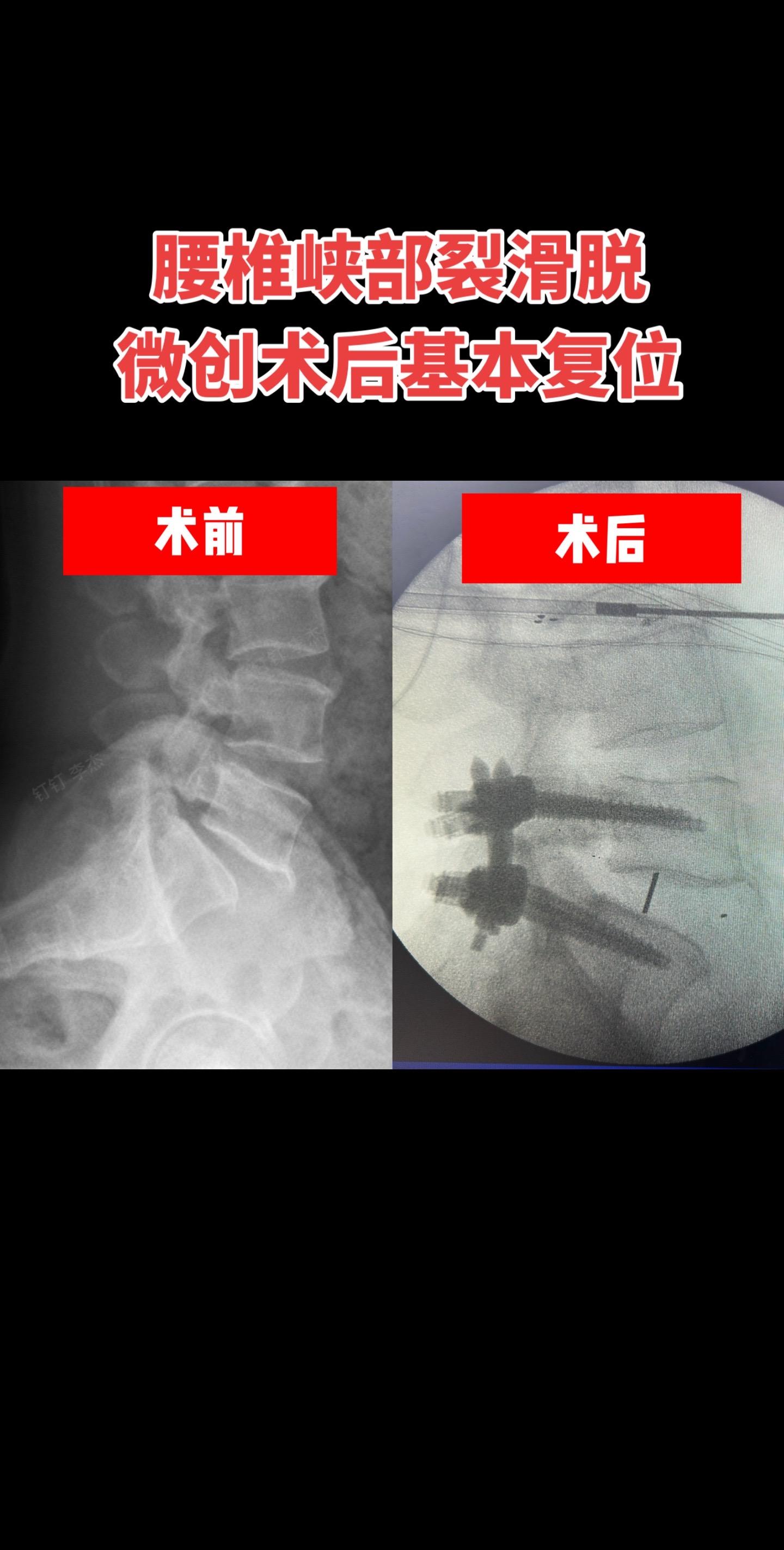 腰椎滑脱微创融合术后基本复位了。腰椎滑脱在没有严重的症状的时候是不需要...