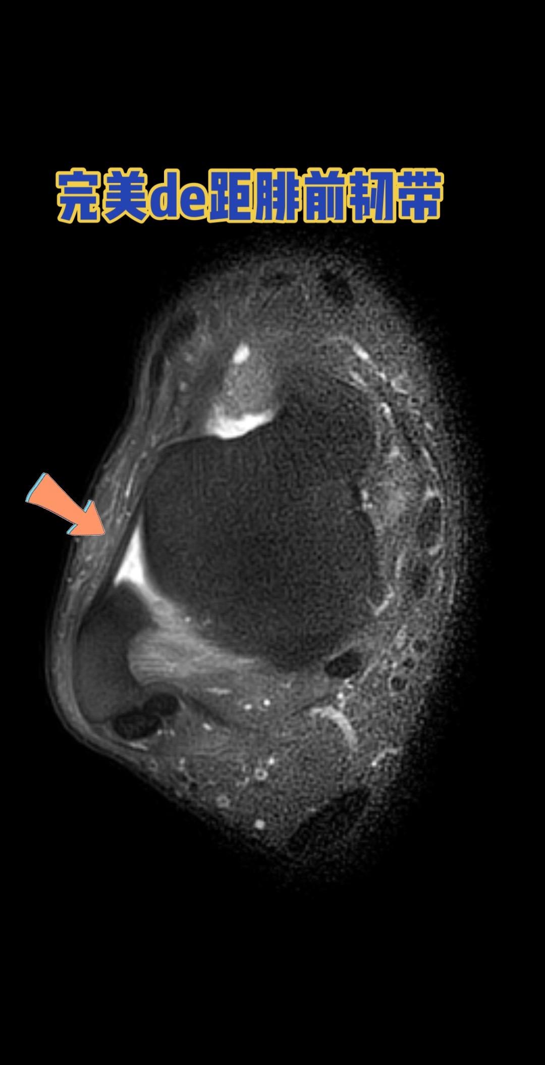 距腓前韧带。👉 健康的距腓前韧带长这样！    距腓前韧带