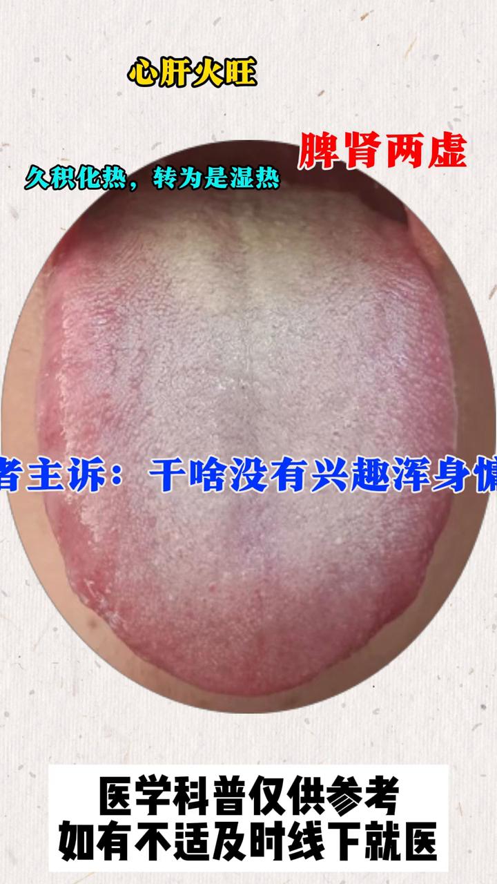 这种白腻苔舌根发黄，脾肾两虚，心肝火旺，湿热，一个虚不受补的舌头。

患者主诉：