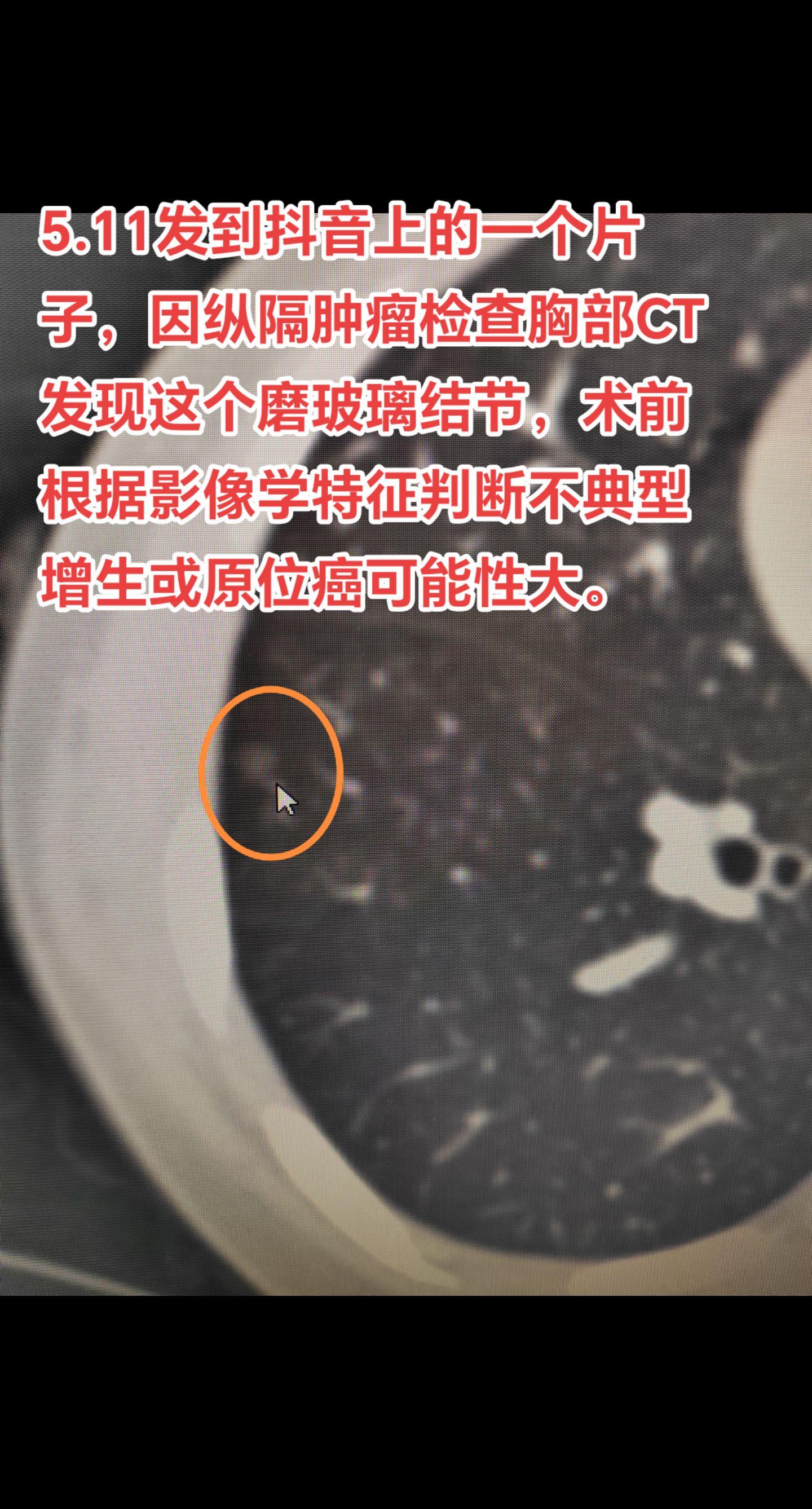 原位癌需要手术治疗吗？如果影像学上高度怀疑原位癌是不需要手术，仅需动态观察即可。但有些情况是需要切除的，比如本例患者，因右侧纵隔肿瘤需要手术，巧合的是结节也在右侧，所以做纵隔肿瘤手术时顺便也把结节切除，这是一举两得的事。
