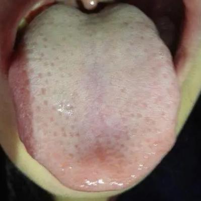 舌边鼓胀的厉害，舌苔白腻，但为什么逍遥散、金匮没用呢？原因就在中气不足！
 
像