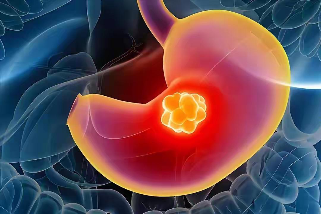 “26岁，胃癌晚期”刷屏背后：这届年轻人的胃，正在被3件“小事”慢慢凌迟


