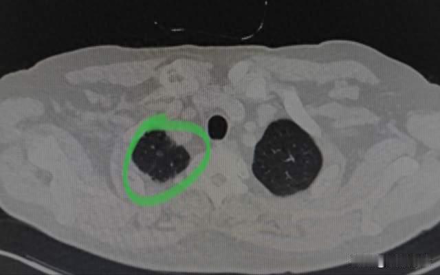 刘懿博士说肺癌（一二〇〇一）三个月后复查新增了5mm磨玻璃结节