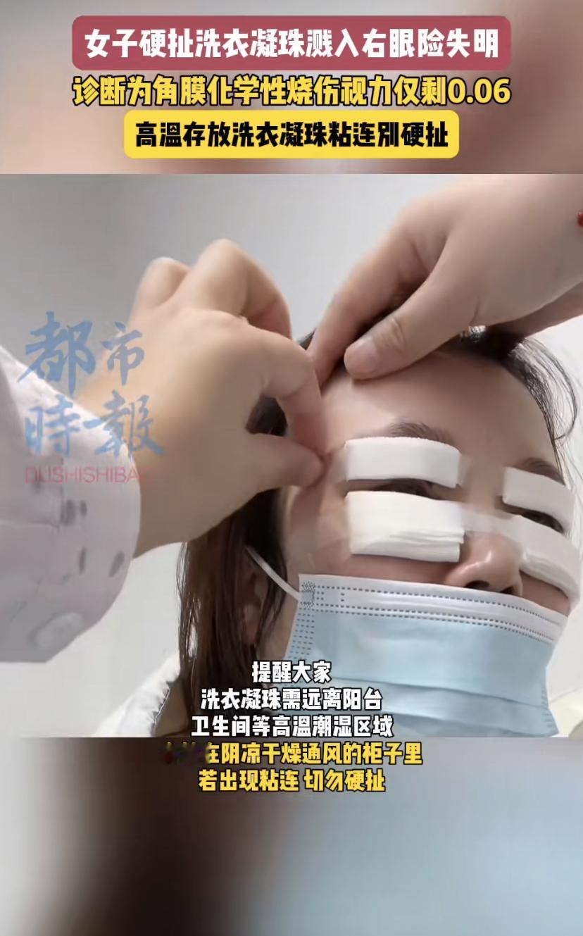太吓人了!杭州一位王女士差点因为一颗洗衣凝珠把眼睛弄瞎。
事情是这样的，她家里囤