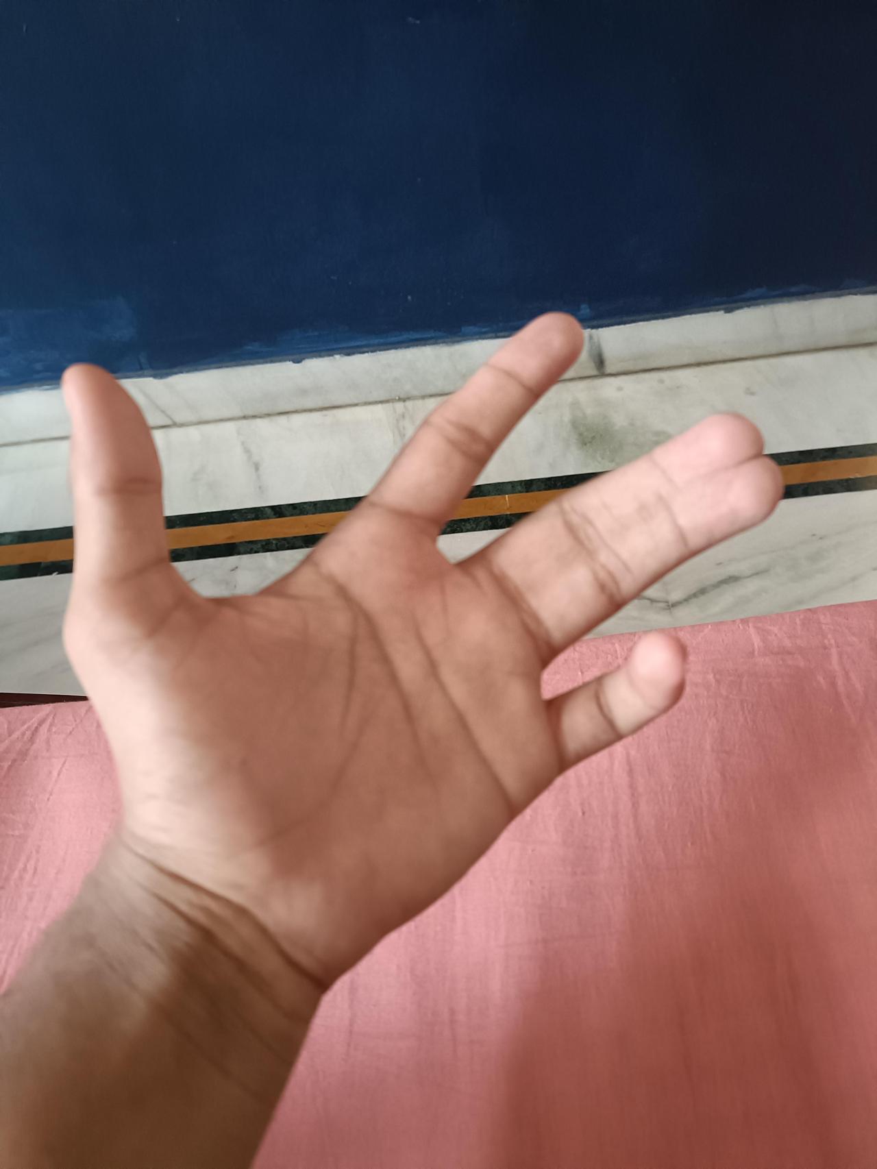 手指并连症的人，从小到大总被问同一个问题：'你是不是小时候用胶水粘的？' 更逗的