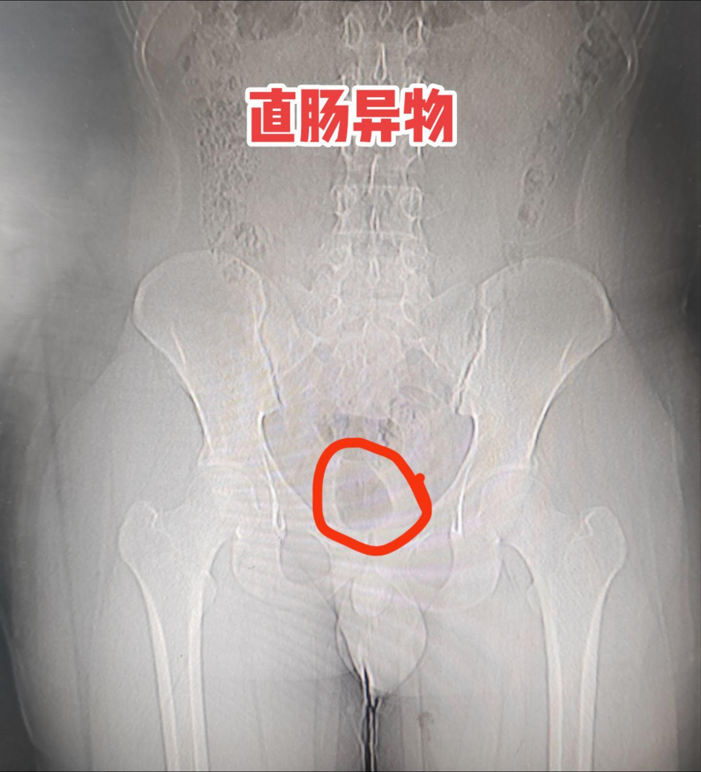 直肠异物。