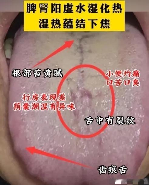 裂纹舌、齿痕舌、厚腻苔，寒湿、湿热、肾气虚，一分钟教你自测

舌象1：舌苔厚腻发