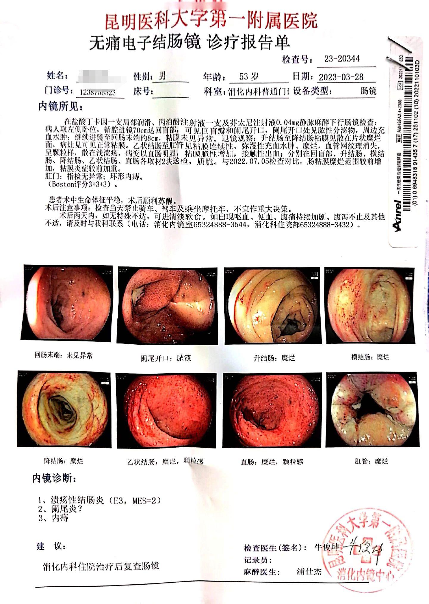 初发型溃疡性结肠炎黏膜愈合相对“容易”。
溃疡性结肠炎，反复发作，导致肠道纤维化，各类药物用上去反应不佳。往往早期就是因为患者不重视这个疾病，停药反复。
但是确诊早期如果能好好管理，治疗，结局往往能够黏膜愈合。