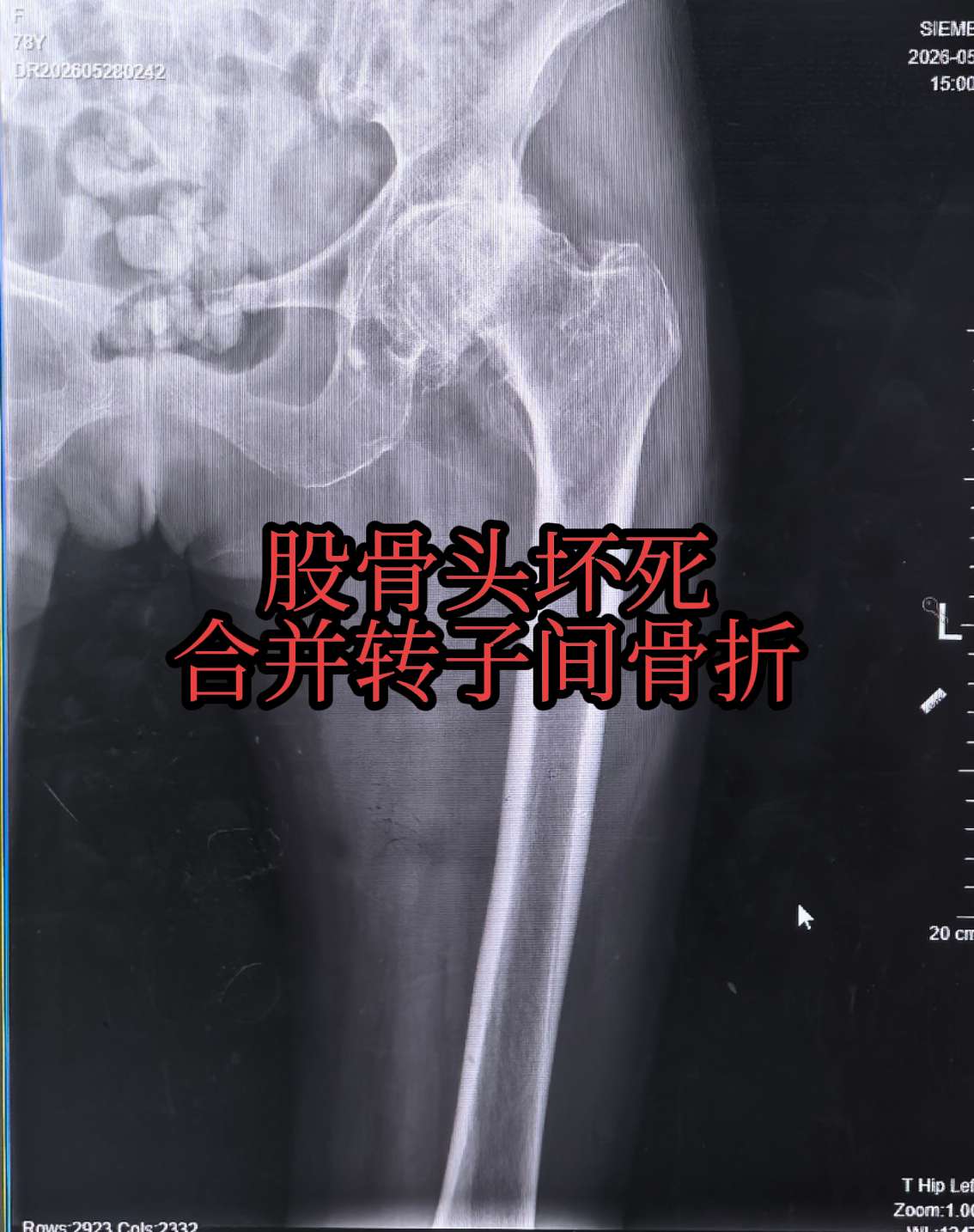髋关节置换。八十岁老太太，股骨头坏死十余年，摔倒致转子间骨折，体质较差...