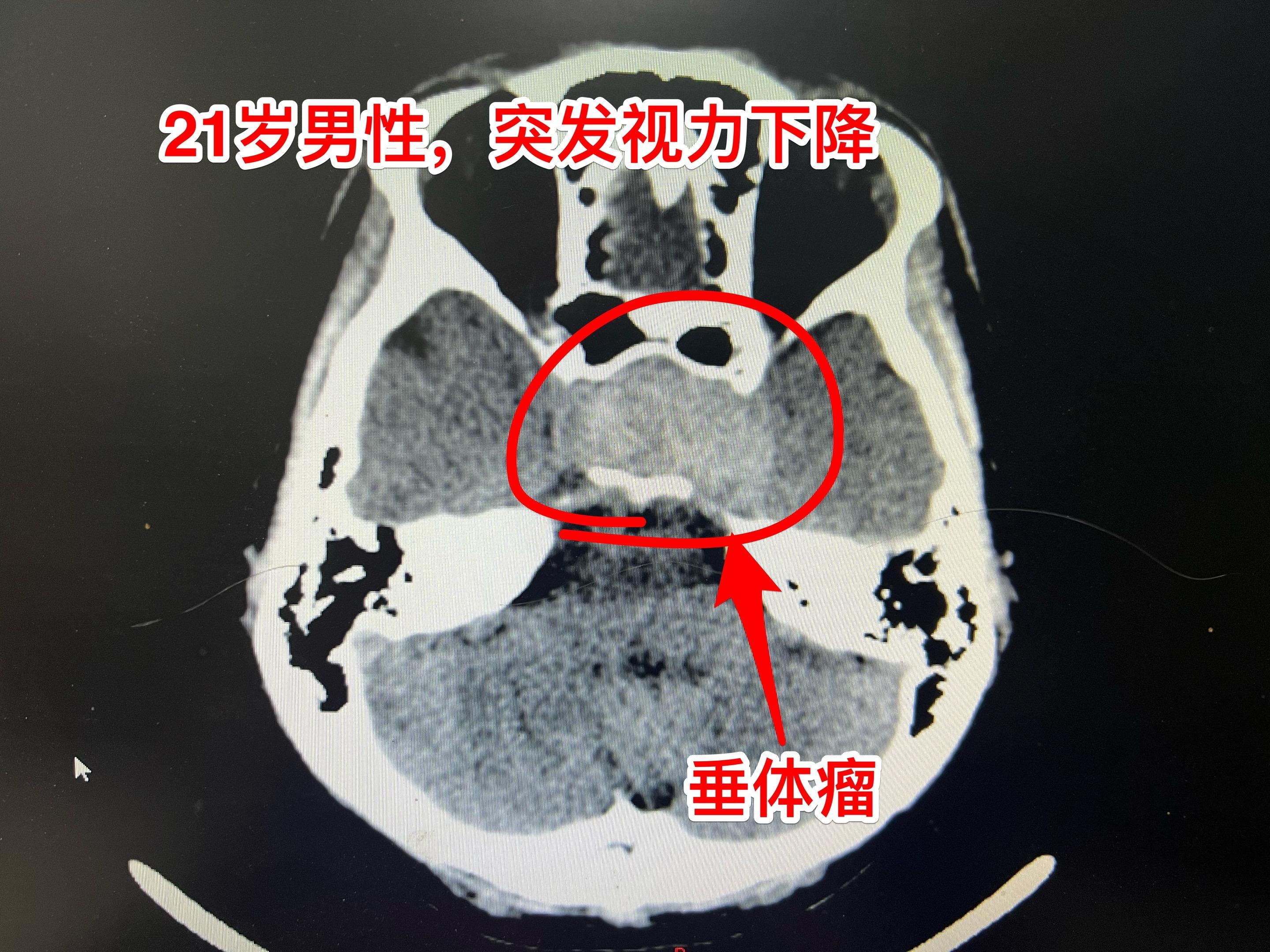 两个月内两个垂体瘤卒中 病例 垂体瘤卒中的最明显的症状是突发视力下降...
