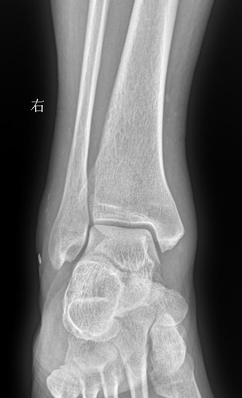 男 71 外伤疼痛20天 软组织肿胀