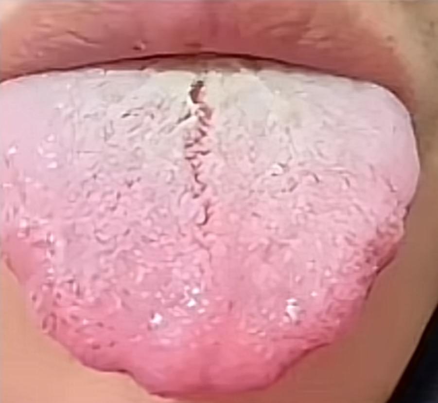 大家好，我是王医生。这种舌象，你光健脾是没有效果的。我们先来看看患者的主诉，平时