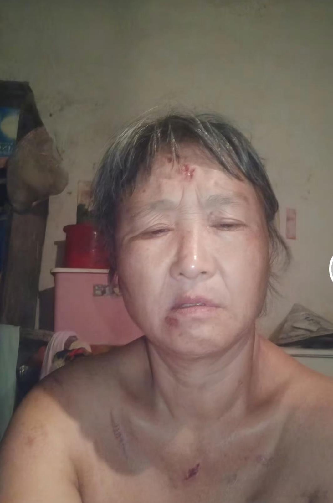 中老年妇女困境这位阿姨身上的伤是被家暴吗看年纪头发都白了，应该有五六十岁的吧，这