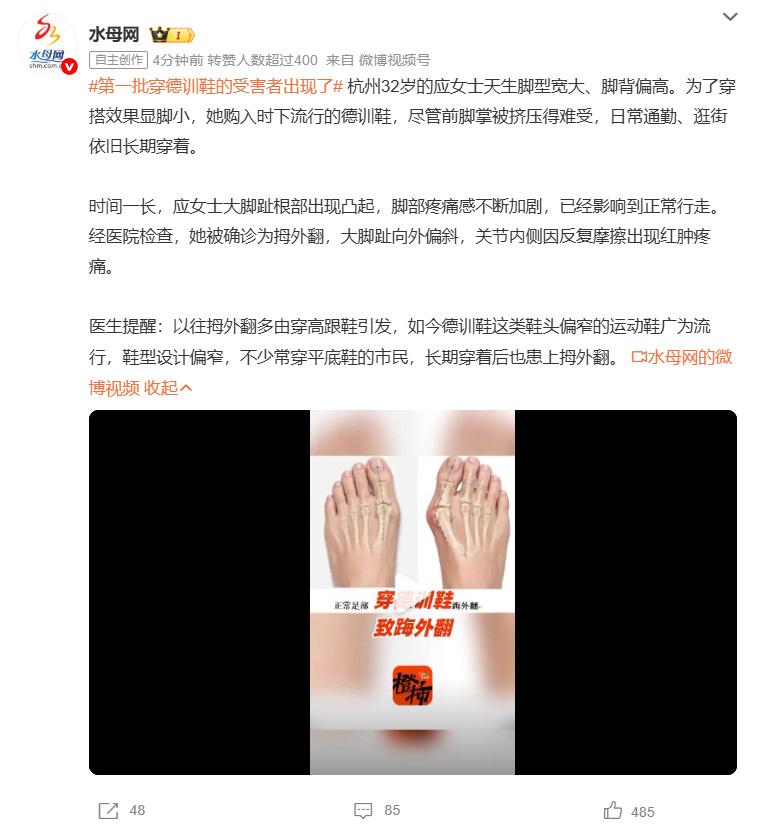 杭州一位32岁的应女士因长期穿着鞋头偏窄的德训鞋，最终确诊拇外翻，走路都疼，引发