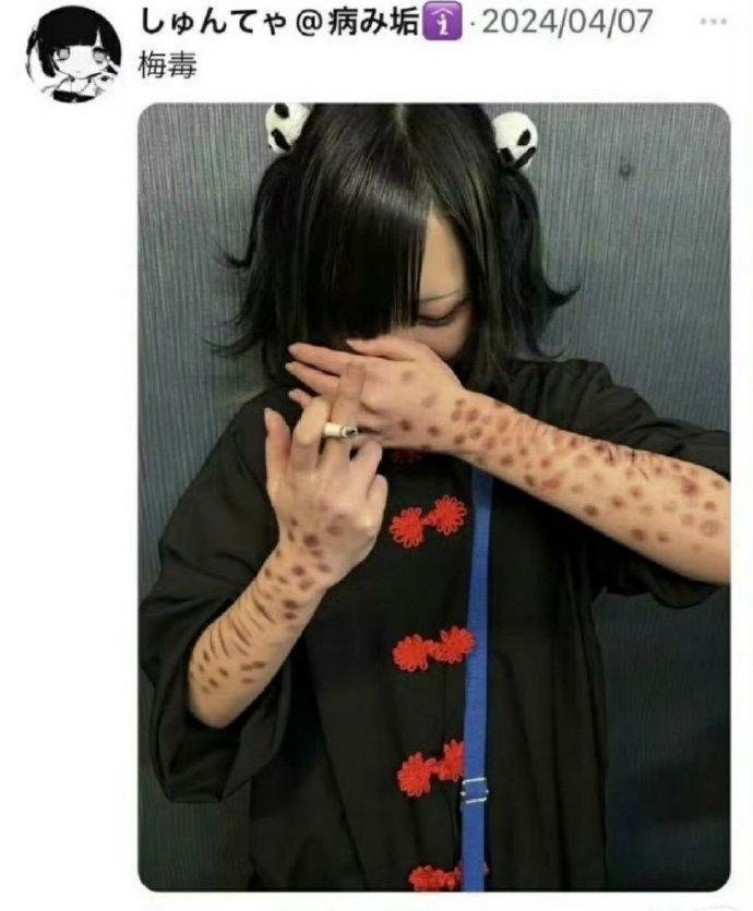日本年轻人集体晒梅毒红疹！4年超1.3万例，病态潮流藏致命坑
 
作为盯健康热点