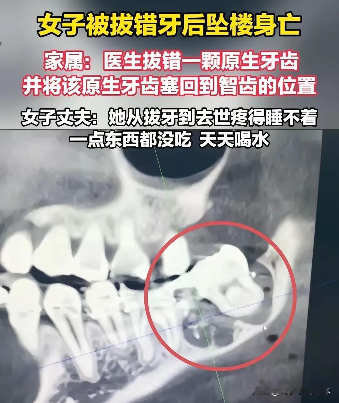 医生想将错就错，却害了一条性命
    如果拔错了牙齿立即栽回去还可以复活，只是