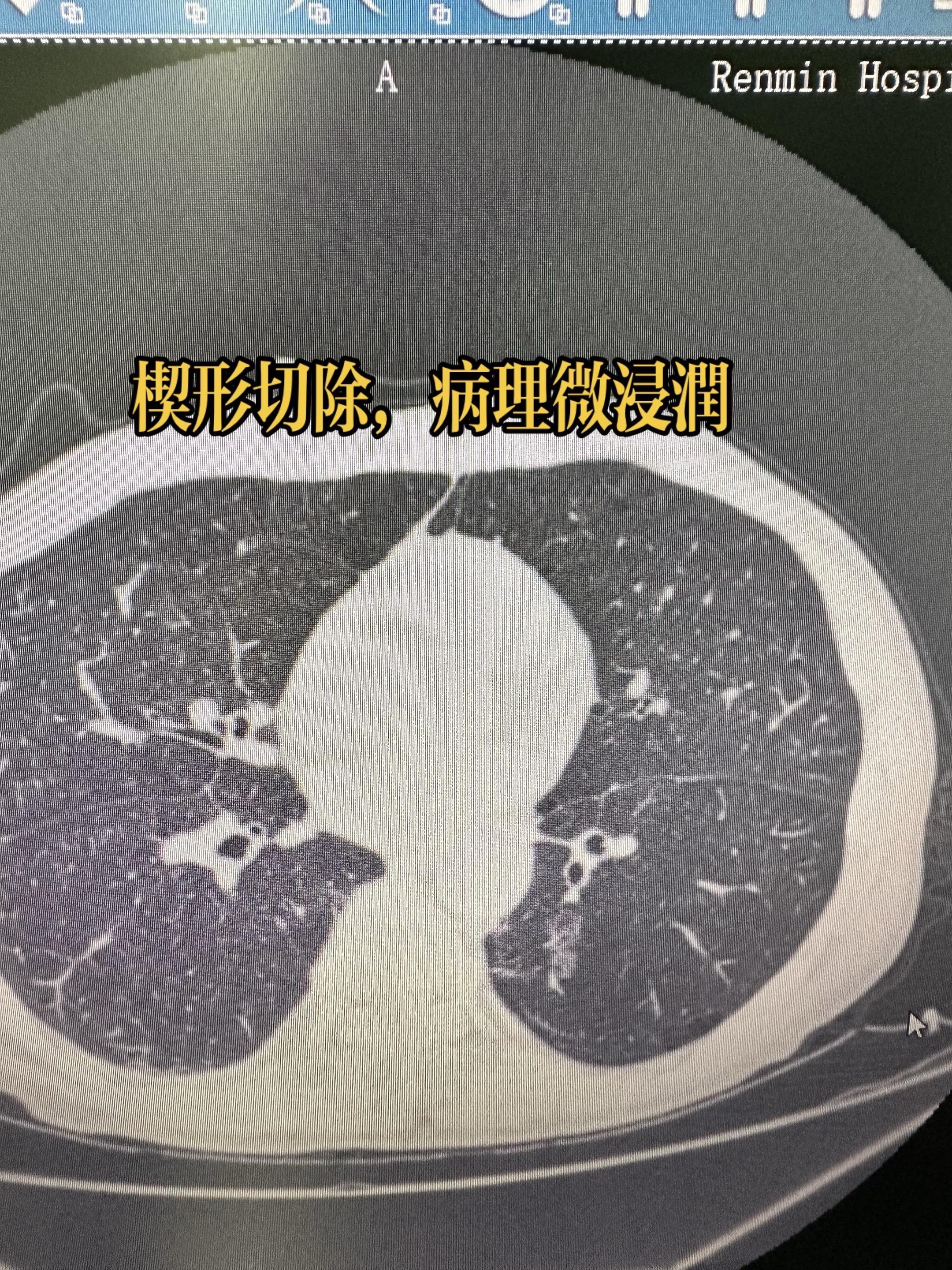 高阶的楔形切除