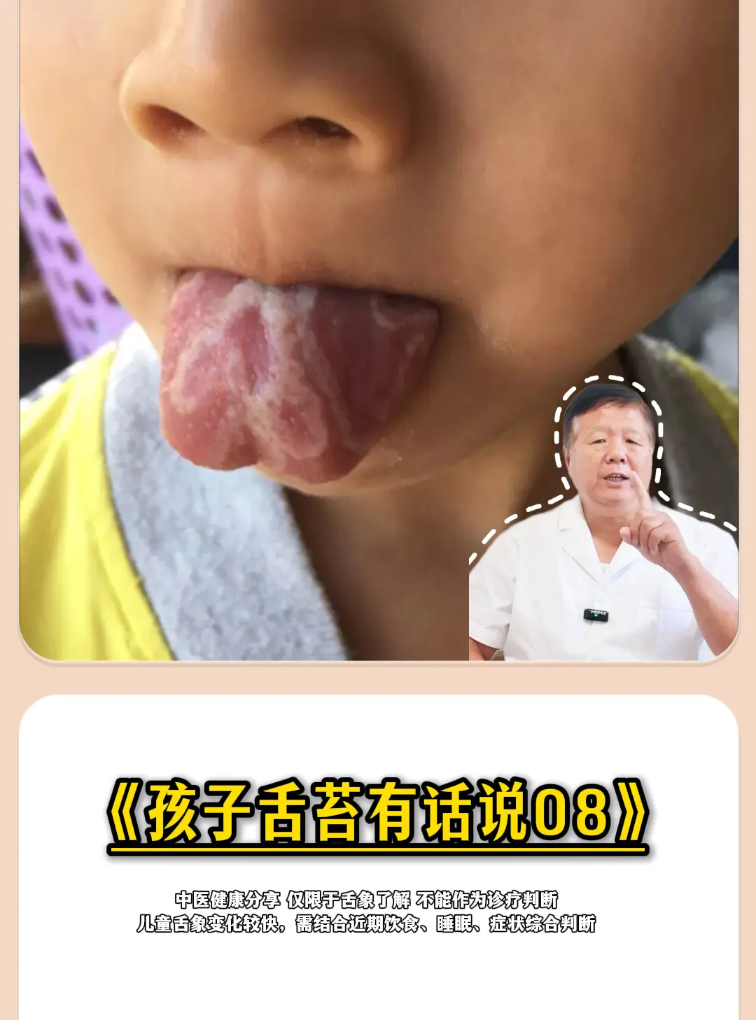 孩子的舌象——地图舌（花剥苔） 舌色偏红，舌苔呈不规则片状剥脱，剥脱处...