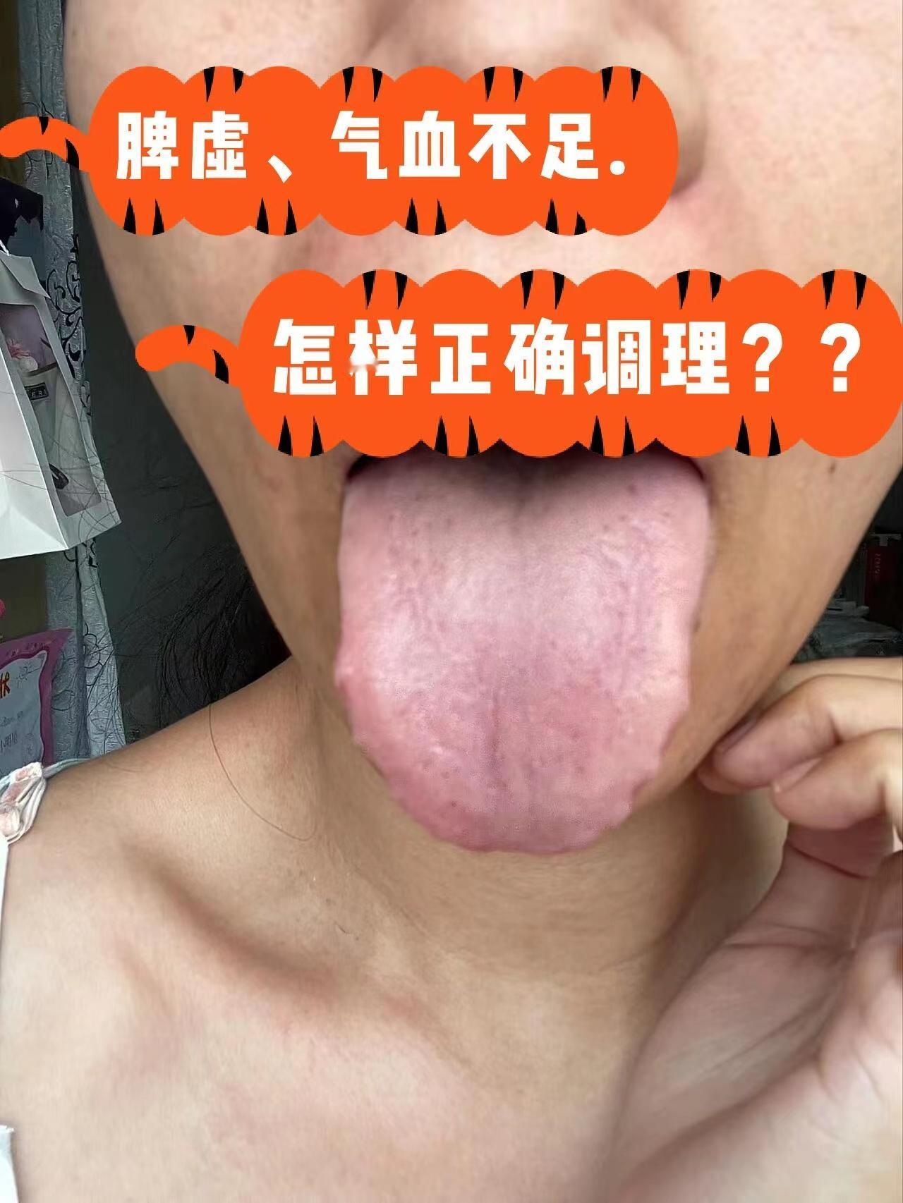 舌诊来聊聊：脾虚的人，气血不足的人[灵光一闪]
脾虚可以说是个中医里人尽皆知的词