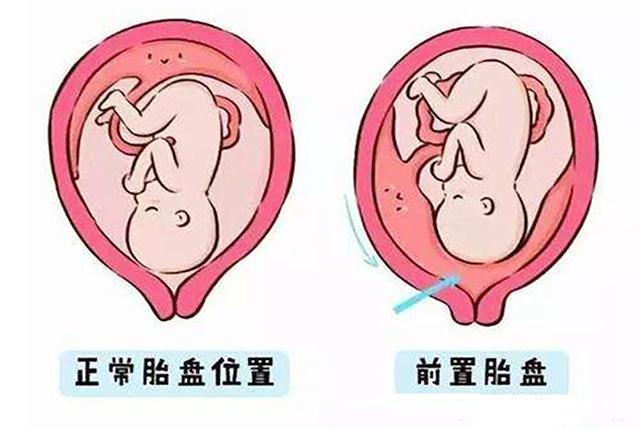 #健康真探社#【如果你被判定这种胎盘，易导致胎儿畸形！】也许很多人没有想到胎盘与